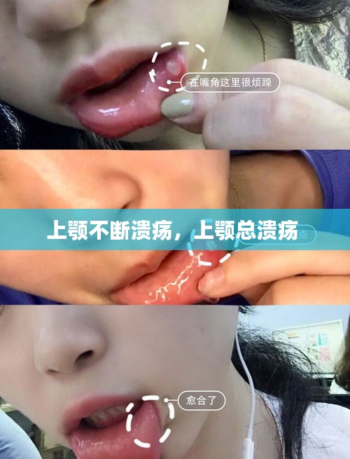 上顎不斷潰瘍，上顎總潰瘍 