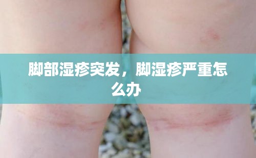 腳部濕疹突發(fā)，腳濕疹嚴(yán)重怎么辦 